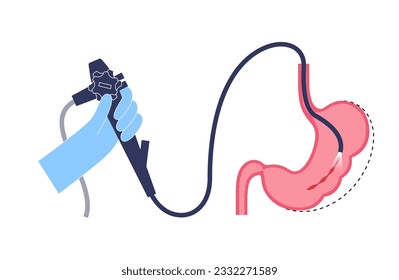 Endoscopic sleeve gastroplasty. Stomach surgery, weight loss gastric procedure. Laparoscopy concept. Overweight problem in human body. Internal organ after operation. Flat vector medical illustration