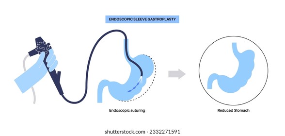 Endoscopic sleeve gastroplasty. Stomach surgery, weight loss gastric procedure. Laparoscopy concept. Overweight problem in human body before and after operation. Flat vector medical illustration