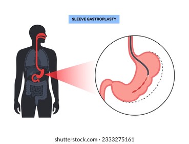 Endoscopic sleeve gastroplasty. Stomach surgery, weight loss gastric procedure. Laparoscopy concept. Overweight problem in human body. Internal organ after operation. Flat vector medical illustration