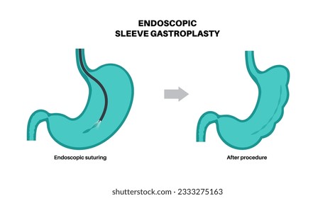 Gastroplastia de manga endoscópica. Cirugía estomacal, procedimiento gástrico de pérdida de peso. Concepto de aparoscopia. Problema de sobrepeso en el cuerpo humano antes y después de la operación. Ilustración médica de vector plano