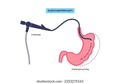 Gastroplastia de manga endoscópica. Cirugía estomacal, procedimiento gástrico de pérdida de peso. Concepto de aparoscopia. Problema de sobrepeso en el cuerpo humano. Órgano interno después de la operación. Ilustración médica de vector plano