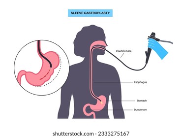 Gastroplastia de manga endoscópica. Cirugía estomacal, procedimiento gástrico de pérdida de peso. Concepto de aparoscopia. Problema de sobrepeso en el cuerpo humano. Órgano interno después de la operación. Ilustración médica de vector plano