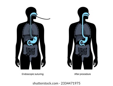 Endoscopic sleeve gastroplasty. Stomach surgery, weight loss gastric procedure. Laparoscopy concept. Overweight problem in human body before and after operation. Flat vector medical illustration