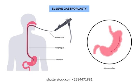 Endoscopic sleeve gastroplasty. Stomach surgery, weight loss gastric procedure. Laparoscopy concept. Overweight problem in human body. Internal organ after operation. Flat vector medical illustration