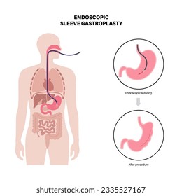 Endoscopic sleeve gastroplasty. Stomach surgery, weight loss gastric procedure. Laparoscopy concept. Overweight problem in human body before and after operation. Flat vector medical illustration