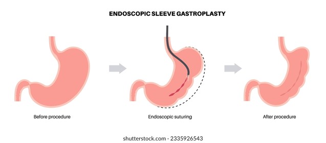 Gastroplastia de manga endoscópica. Cirugía estomacal, procedimiento gástrico de pérdida de peso. Concepto de aparoscopia. Problema de sobrepeso en el cuerpo humano antes y después de la operación. Ilustración médica de vector plano