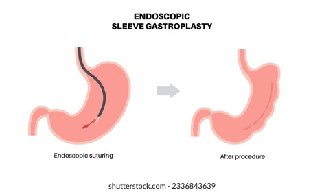 Gastroplastia de manga endoscópica. Cirugía estomacal, procedimiento gástrico de pérdida de peso. Concepto de aparoscopia. Problema de sobrepeso en el cuerpo humano antes y después de la operación. Ilustración médica de vector plano