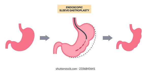 Gastroplastia de manga endoscópica. Cirugía estomacal, procedimiento gástrico de pérdida de peso. Concepto de aparoscopia. Problema de sobrepeso en el cuerpo humano antes y después de la operación. Ilustración médica de vector plano