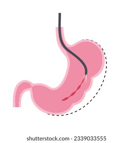 Gastroplastia de manga endoscópica. Cirugía estomacal, procedimiento gástrico de pérdida de peso. Concepto de aparoscopia. Problema de sobrepeso en el cuerpo humano. Órgano interno después de la operación. Ilustración médica de vector plano