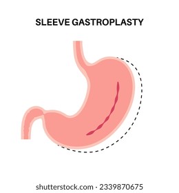Endoscopic sleeve gastroplasty. Stomach surgery, weight loss gastric procedure. Laparoscopy concept. Overweight problem in human body. Internal organ after operation. Flat vector medical illustration