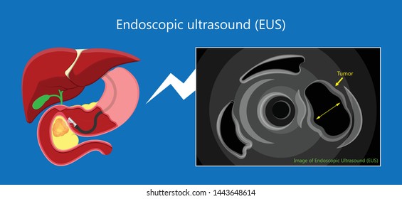 endoscopic ultrasound EUS cancer tumor diagnose FNA
abdominal test CT scan MRI colon stomach gastric
rectal organs examine rectum Acute abnormal
esophageal needle pain ulcer