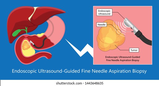 endoscopic ultrasound EUS cancer tumor diagnose FNA
abdominal test CT scan MRI colon stomach gastric
rectal organs examine rectum Acute abnormal
esophageal needle pain ulcer
