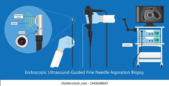 endoscopic ultrasound EUS cancer tumor diagnose FNA
abdominal test CT scan MRI colon stomach gastric
rectal organs examine rectum Acute abnormal
esophageal needle pain ulcer