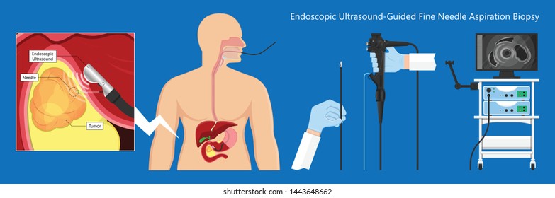 endoscopic ultrasound EUS cancer tumor diagnose FNA
abdominal test CT scan MRI colon stomach gastric
rectal organs examine rectum Acute abnormal
esophageal needle pain ulcer