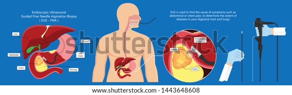 Endoscopic Ultrasound Eus Cancer Tumor Diagnose Stock Vector (Royalty ...