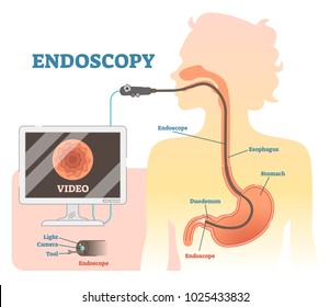 Endoscopy anatomical vector illustration diagram, medical scheme with endoscope monitoring, esophagus, and stomach.