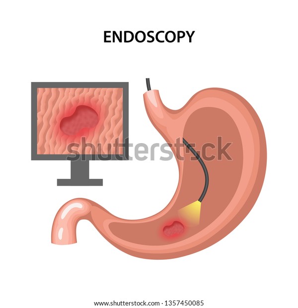 Endoscopy Diagnostic Human Stomach Ulcer Human 库存矢量图（免版税）1357450085