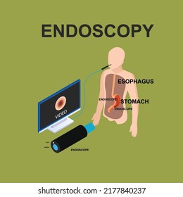 Endoscopy for GERD isometric 3d vector illustration concept for banner, website, illustration, landing page, flyer, etc.