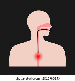 Endoscopy Procedure In Clinic. Esophageal Carcinoma. Internal Organs Exam. Endoscope In The Human Esophagus. Inflammation, Pain, Tumor In Human Digestive System. Oesophagus Cancer Vector Illustration