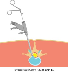 Endoscopy Spine Surgery Method With An Endoscope Vector Illustration