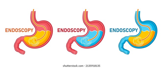 Endoscopy stomach, gastroscopy icon set. Gastroenterology endoscope, medical examination digestive tract system, treatment gastritis, heartburn, ulcer internal organ. Health care procedure flat vector
