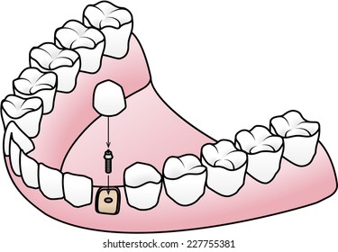 Endosteal or Endosseous implant: the implant is placed into the jaw bone with an abutment to which the prosthesis is attached.