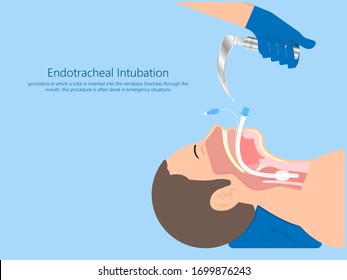 Endotracheal intubation ICU care unit COVID 19 larynx  throat rescue surgery mouth Tube trachea breathe ventilation deliver oxygen lungs insert sedate rest airway foreign body removal block aspiration