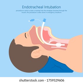 Endotracheal intubation ICU care unit COVID 19 larynx  throat rescue surgery mouth Tube trachea breathe ventilation deliver oxygen lungs insert sedate rest airway foreign body removal block aspiration