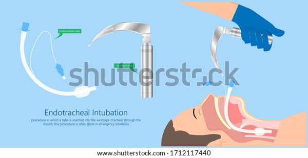 endotracheal-intubation-icu-care-unit-600w-1712117440.jpg