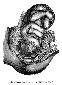 Engagement and descent of the head, vintage engraved illustration. Usual Medicine Dictionary by Dr Labarthe - 1885