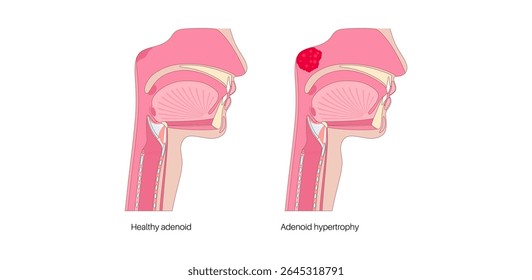 Enlarged adenoids in the nasopharynx medical poster. Sagittal view of a childs or adults head showing swollen lymphoid tissue obstructing airflow through the nasal passage medical vector illustration