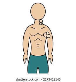 Enlarged lymph nodes. Color vector illustration. The patient has inflamed lymph nodes in the neck and armpits. A symptom of a disorder in the body. Isolated background. Cartoon style. Medical theme. 