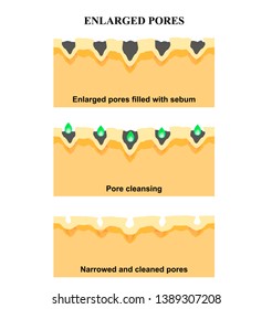 Enlarged pores. The structure of the skin. Wrinkles, acne scar. Cleansing and narrowing the pores. Infographics. Vector illustration on isolated background.