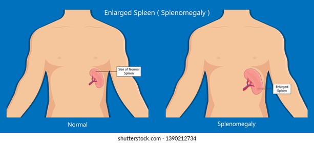 normal and enlarged spleen