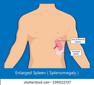 normal and enlarged spleen