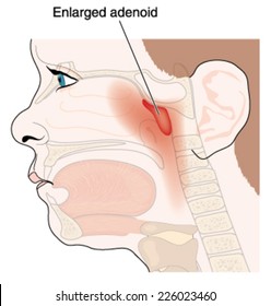 Enlargement of adenoid glands in children, showing the anatomic position of the adenoid gland in the nasopharynx. Created in Adobe Illustrator.  Contains transparencies.  EPS 10.