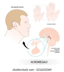 El trastorno del gigantismo con síntoma de aumento de la cara y la mano que causa la liberación cerebral supera a las hormonas