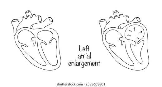 Enlargement of the left atrium in as a result of prolonged overload of the cardiac chamber. A healthy heart drawn with a black line and a heart with left atrium dilatation. Vector illustration.