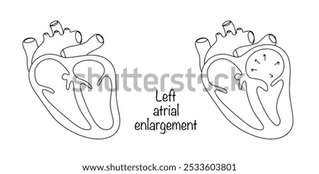 Enlargement of the left atrium in as a result of prolonged overload of the cardiac chamber. A healthy heart drawn with a black line and a heart with left atrium dilatation. Vector illustration.