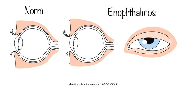 Enoftalmo. Uma condição patológica do globo ocular, na qual ele é excessivamente retraído para a cavidade orbital. Ilustração de vetor de cores simples para uso no campo médico.