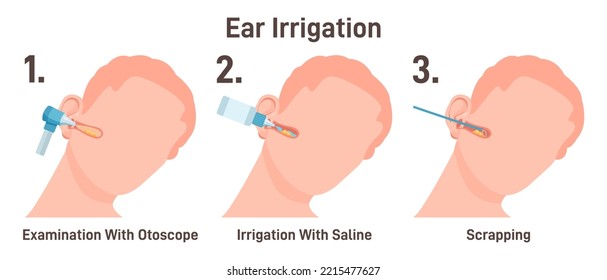 El médico de ENT irriga los oídos. El médico verifica los canales de los oídos, retirando la cera de los oídos con solución salina. Paciente en revisión médica en cita con un especialista en otolaringología. Ilustración vectorial plana