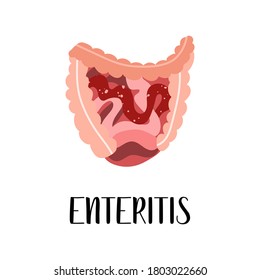 Enteritis, inflammation of the small intestine. Gut diseases. Gastroenterology. Vector flat illustration. Perfect for flyer, medical brochure, banner, landing page, website
