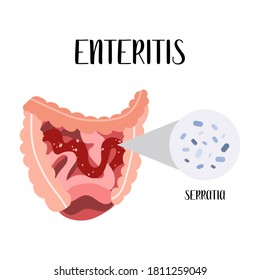 Enteritis, inflammation of the small intestine. Serratia bacteria. Gut diseases. Gastroenterology. Vector flat illustration. Perfect for flyer, medical brochure, banner, landing page, website