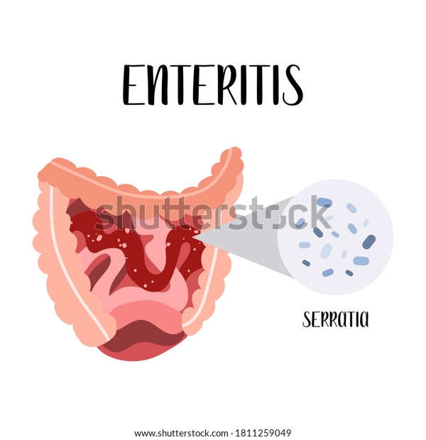 Enteritis Inflammation Small Intestine Serratia Bacteria Stock Vector 