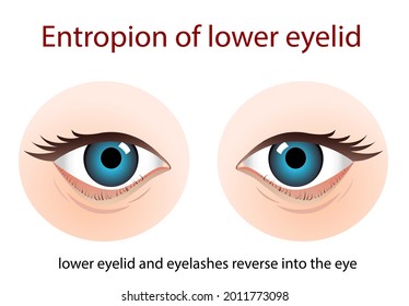 Entropión, una condición en la que el párpado se vuelve hacia dentro contra el globo ocular,