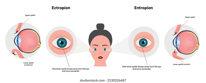 Problema ocular com o entrópio e o ectópio oftalmológico