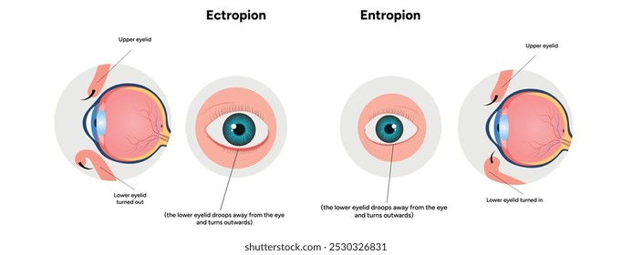 Entropion and ectopion ophthalmology eye problem