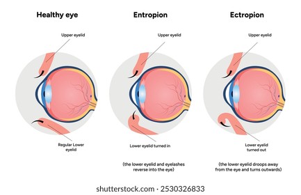 Entropion and ectopion ophthalmology eye problem