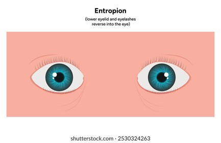 Entropion eye ophthalmology infographic diagram 