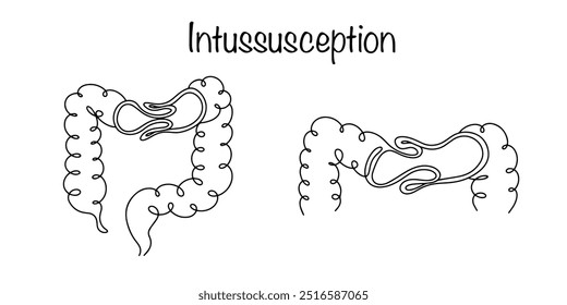 A entrada de uma parte do intestino no lúmen de outra parte com interrupção da motilidade intestinal. Estado patológico agudo. Ilustração vetorial para uso no campo médico.